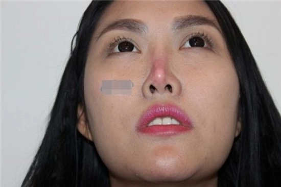 Người nổi tiếng từng gặp biến chứng sau dao kéo có người phải sống mãi với gương mặt đáng sợ - 8