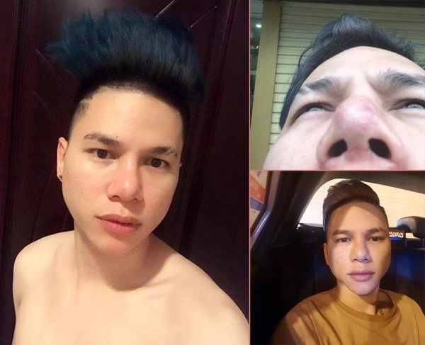 Người nổi tiếng từng gặp biến chứng sau dao kéo có người phải sống mãi với gương mặt đáng sợ - 16