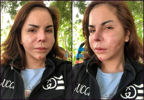 Người nổi tiếng từng gặp biến chứng sau dao kéo có người phải sống mãi với gương mặt đáng sợ - 21