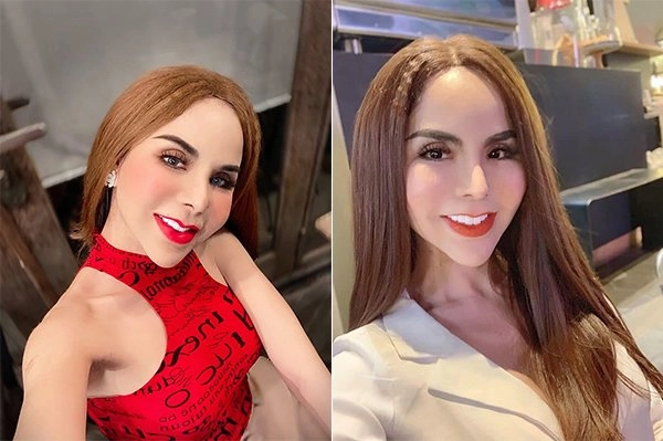 Người nổi tiếng từng gặp biến chứng sau dao kéo có người phải sống mãi với gương mặt đáng sợ - 22