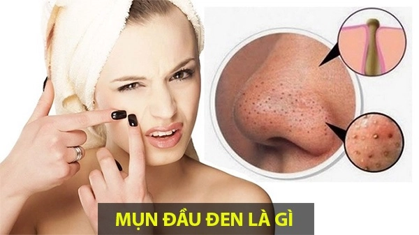 10 cách trị mụn đầu đen ở mũi má trán an toàn hiệu quả nhanh nhất - 1