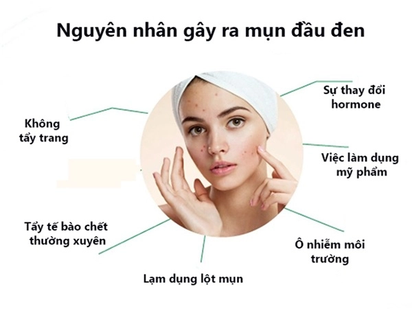 10 cách trị mụn đầu đen ở mũi má trán an toàn hiệu quả nhanh nhất - 2