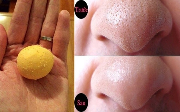 10 cách trị mụn đầu đen ở mũi má trán an toàn hiệu quả nhanh nhất - 4