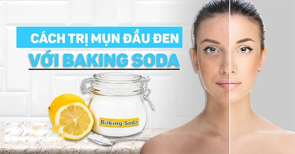 10 cách trị mụn đầu đen ở mũi má trán an toàn hiệu quả nhanh nhất - 7
