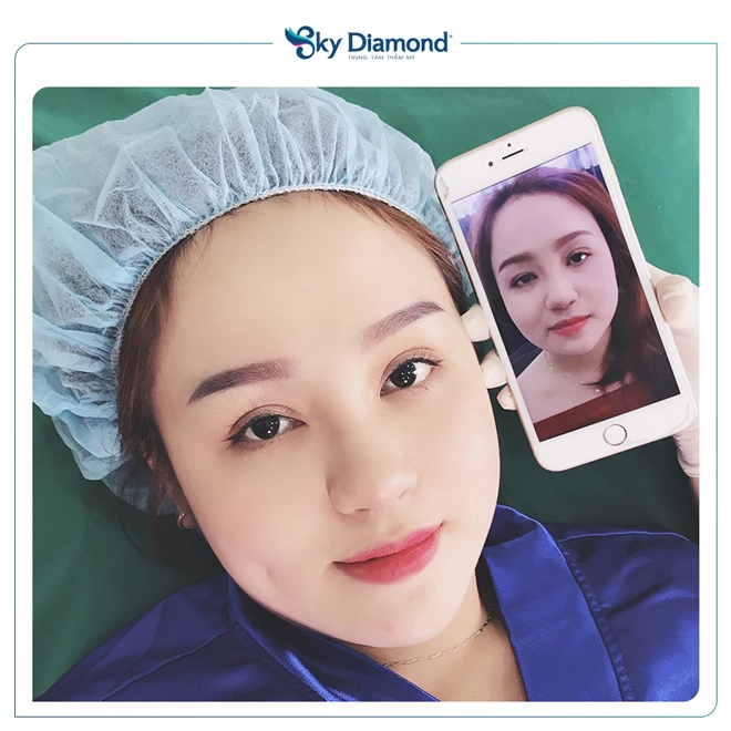 Phụ nữ trung niên nên treo mày hay cắt mí - 2