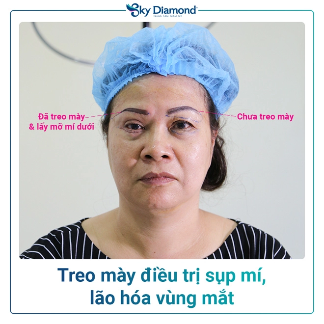 Phụ nữ trung niên nên treo mày hay cắt mí - 4