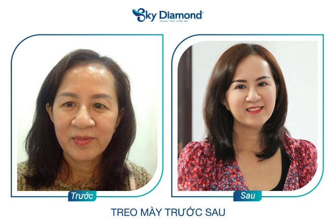 Phụ nữ trung niên nên treo mày hay cắt mí - 6