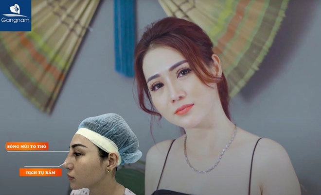 Sửa mũi hỏng tại thẩm mỹ viện gangnam - 4