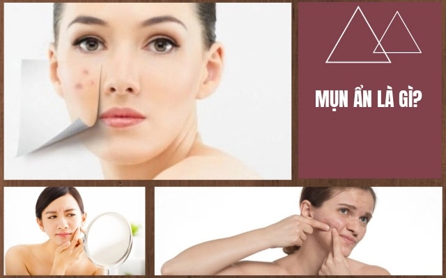 10 cách trị mụn ẩn dưới da tại nhà an toàn hiệu quả nhanh nhất - 1