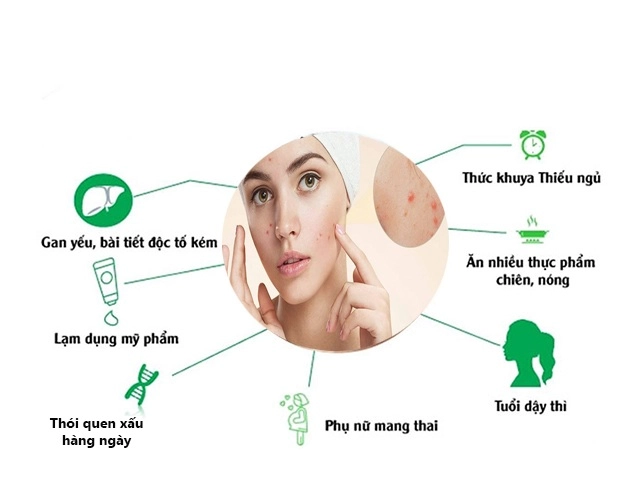 10 cách trị mụn ẩn dưới da tại nhà an toàn hiệu quả nhanh nhất - 2