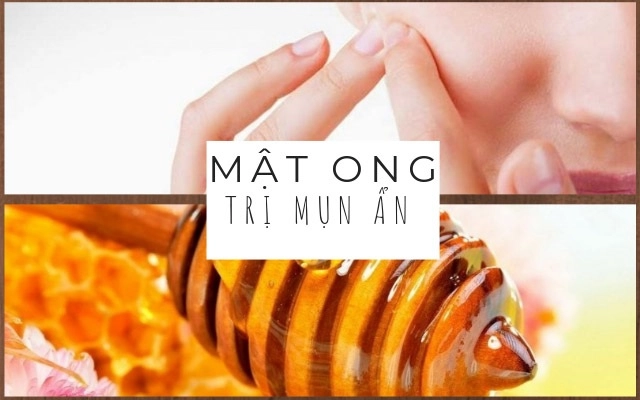 10 cách trị mụn ẩn dưới da tại nhà an toàn hiệu quả nhanh nhất - 3