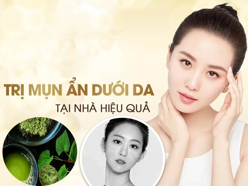10 cách trị mụn ẩn dưới da tại nhà an toàn hiệu quả nhanh nhất - 5
