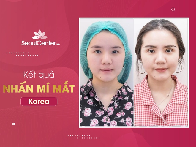 5 điểm khác biệt khi nhấn mí hàn quốc tại seoul center - 4