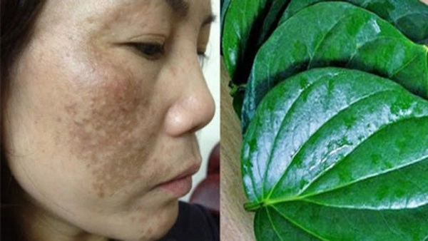 7 loại mặt nạ trị nám đắp đến đâu da tự khắc trắng hồng đến đó hết sạch thâm sạm - 5