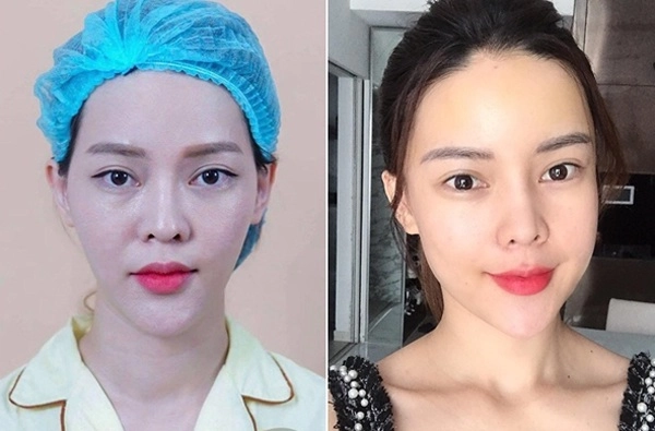 Băn khoăn giữa cấy mỡ tự thân và tiêm filler nàng nên chọn phương pháp nào làm đẹp gương mặt - 4