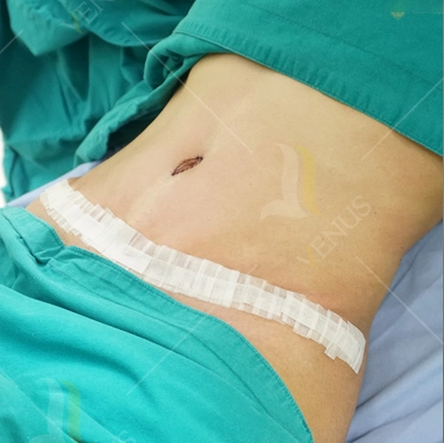 Bs nguyễn đắc linh giúp chị em tìm lại sự tự tin nhờ phẫu thuật tạo hình thành bụng - 2