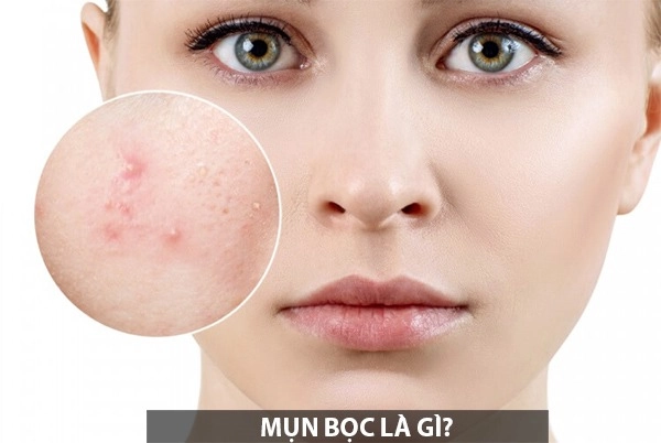Cách trị mụn bọc sưng đỏ mủ ở mũi cằm tại nhà an toàn hiệu quả - 1