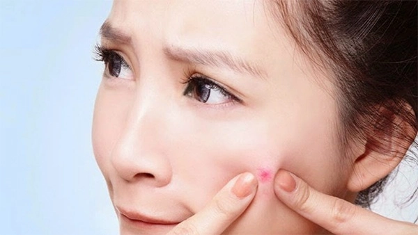 Cách trị mụn bọc sưng đỏ mủ ở mũi cằm tại nhà an toàn hiệu quả - 2