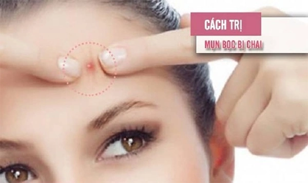 Cách trị mụn bọc sưng đỏ mủ ở mũi cằm tại nhà an toàn hiệu quả - 5