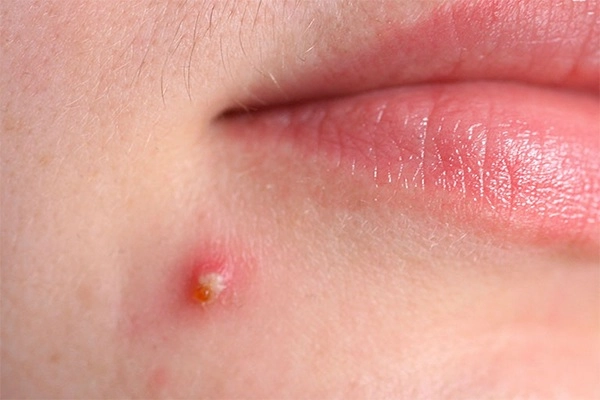 Cách trị mụn bọc sưng đỏ mủ ở mũi cằm tại nhà an toàn hiệu quả - 6