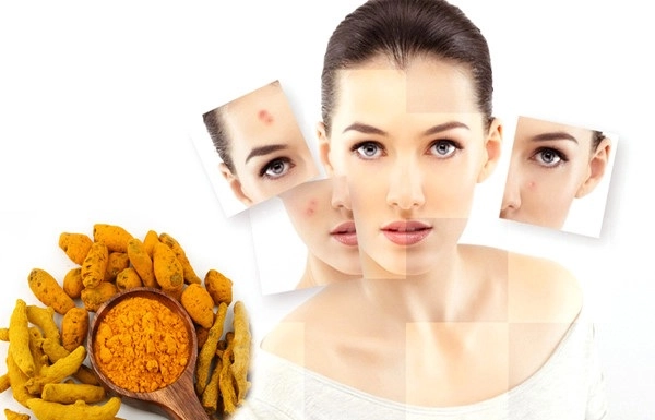 Cách trị mụn thâm tại nhà hiệu quả nhanh nhất từ tự nhiên - 3