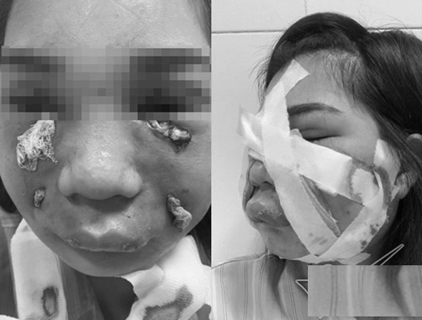 Cấy mỡ tự thân làm chị em lao đao người mặt sưng phù người qua đời trên bàn phẫu thuật - 2