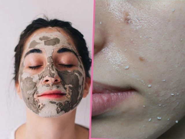 Chăm sóc da mụn thâm đúng cách an toàn đơn giản tại nhà - 5