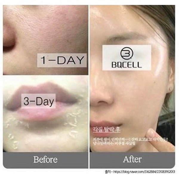 Da đầy khuyết điểm trở nên trắng mịn không tì vết nhờ vào quy trình peel 3 bước dưới đây - 2