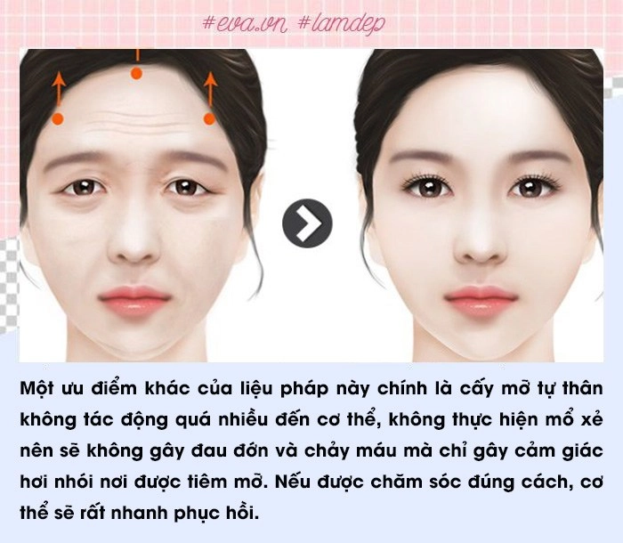 Để không gặp biến chứng nàng lưu ngay các sai lầm phổ biến thường gặp khi cấy mỡ tự thân - 3