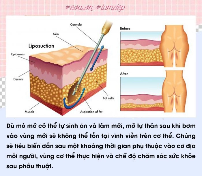 Để không gặp biến chứng nàng lưu ngay các sai lầm phổ biến thường gặp khi cấy mỡ tự thân - 4