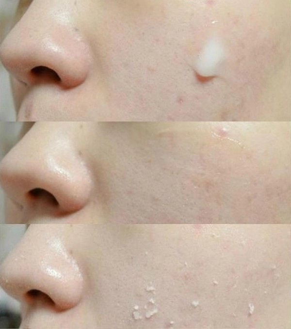 Không nắm ngay bí kíp chăm sóc da dầu bị mụn nàng sai 1 li đi 1 dặm - 4