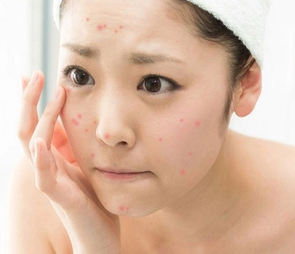 Không nắm ngay bí kíp chăm sóc da dầu bị mụn nàng sai 1 li đi 1 dặm - 6