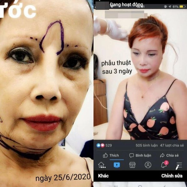 Mới căng da mặt xong cô dâu cao bằng lại muốn trùng tu vòng 1 liệu có quá vội vàng - 2
