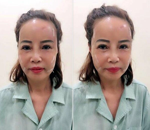 Mới căng da mặt xong cô dâu cao bằng lại muốn trùng tu vòng 1 liệu có quá vội vàng - 4