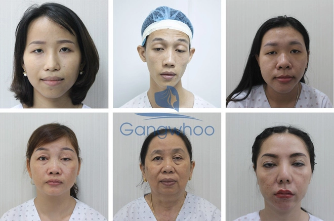 Thẩm mỹ viện gangwhoo bật mí kỹ thuật sửa mắt sụp mí - 1
