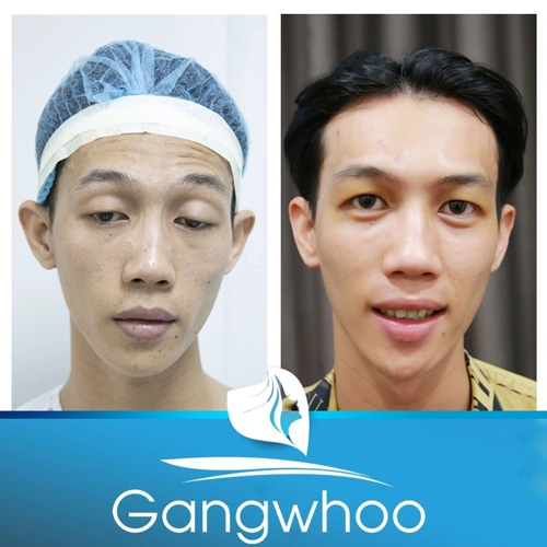 Thẩm mỹ viện gangwhoo bật mí kỹ thuật sửa mắt sụp mí - 2