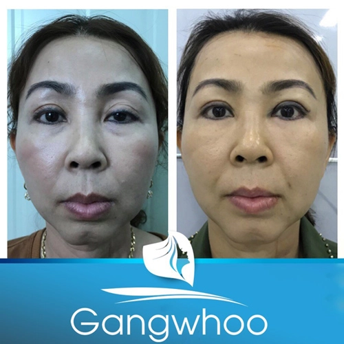 Thẩm mỹ viện gangwhoo bật mí kỹ thuật sửa mắt sụp mí - 3