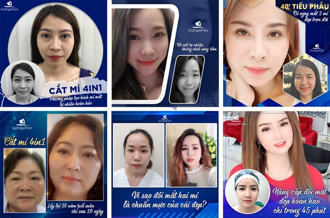 Thẩm mỹ viện gangwhoo bật mí kỹ thuật sửa mắt sụp mí - 4