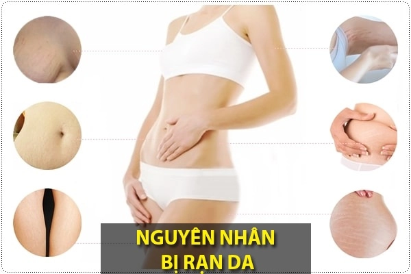 Trị rạn da sau sinh lâu năm hiệu quả nhanh nhất hiện nay - 1