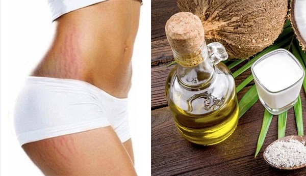 Trị rạn da sau sinh lâu năm hiệu quả nhanh nhất hiện nay - 2
