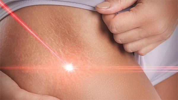 Trị rạn da sau sinh lâu năm hiệu quả nhanh nhất hiện nay - 7