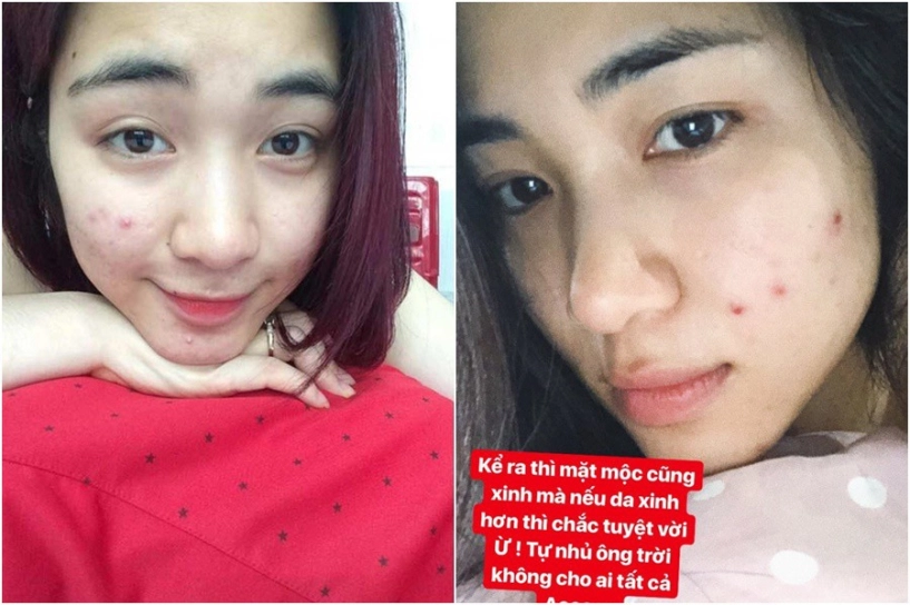 Tưởng làn da hoàn hảo dàn mỹ nhân cũng từng khóc ròng vì mụn chi chít kéo đầy lên mặt - 1