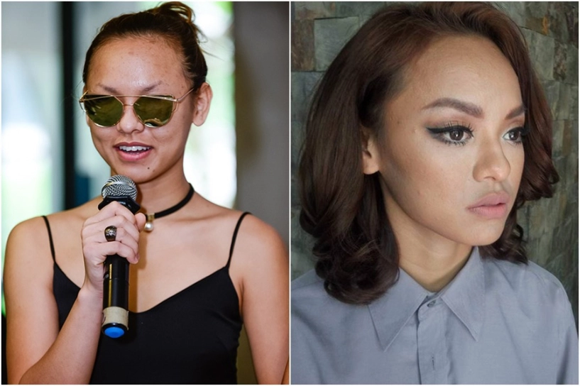 Tưởng làn da hoàn hảo dàn mỹ nhân cũng từng khóc ròng vì mụn chi chít kéo đầy lên mặt - 5