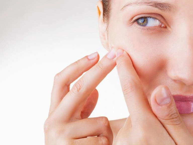 Tưởng làn da hoàn hảo dàn mỹ nhân cũng từng khóc ròng vì mụn chi chít kéo đầy lên mặt - 11
