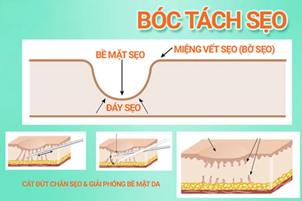 Xóa sẹo rỗ hiệu quả với phương pháp bóc tách sẹo - 1