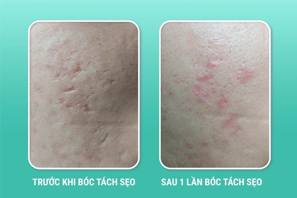 Xóa sẹo rỗ hiệu quả với phương pháp bóc tách sẹo - 2