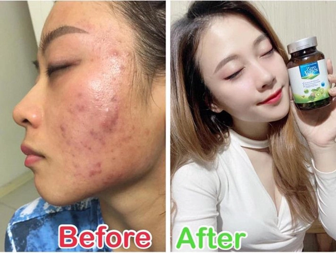 Zero acnes - phuong phap lam đep giam mun từ sâu bên trong - 2