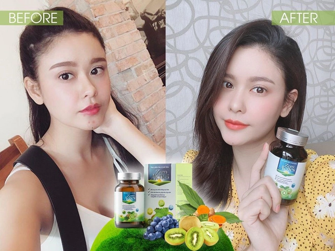 Zero acnes - phuong phap lam đep giam mun từ sâu bên trong - 4