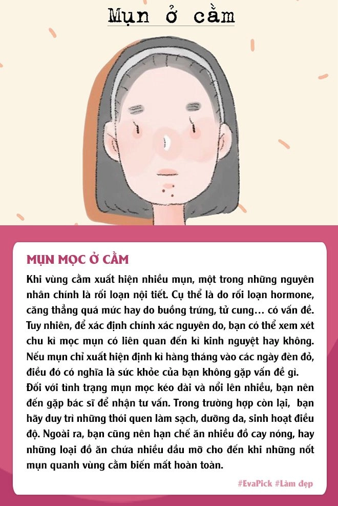 6 vị trí mụn mọc thường gặp trên gương mặt nói gì về tình trạng cơ thể bạn - 3