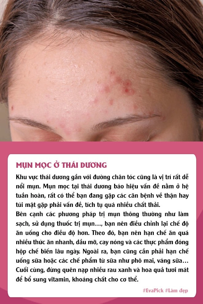 6 vị trí mụn mọc thường gặp trên gương mặt nói gì về tình trạng cơ thể bạn - 4
